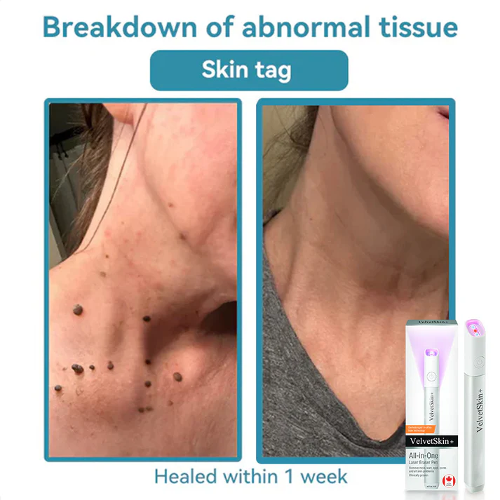 Xalnora™ All-in-One CO₂ Laser Eraser Pen | Removes Moles, Warts, Skin Flaws & Pigmentation