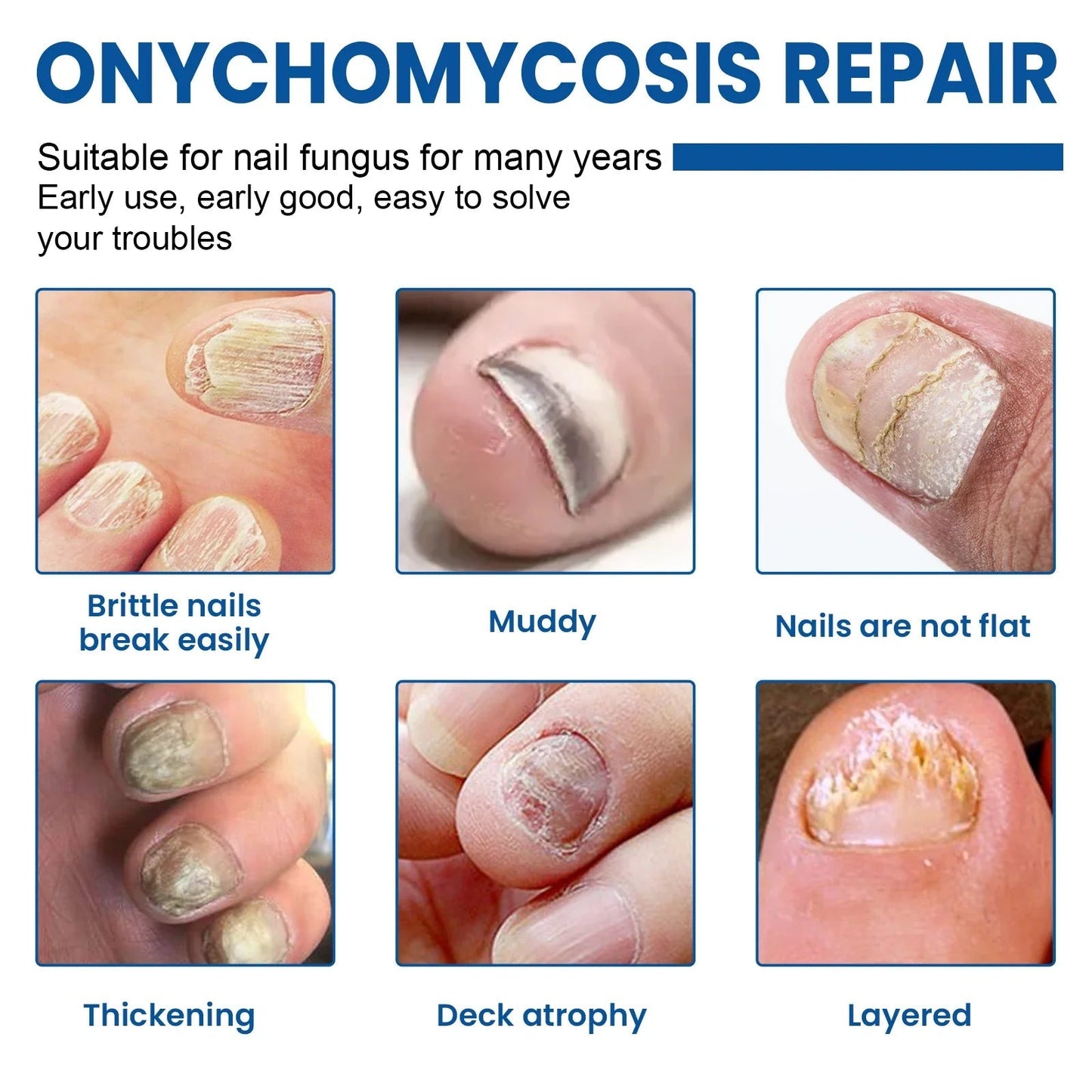 🔥 Last Day 50% OFF CURALONA® Nail Fungus Care Patches 🩹 From Yellow, Brittle-Looking Nails to Clearer, Healthier-Looking Nails